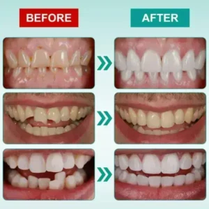 🦷𝗢𝘂𝗿𝗹𝘆𝗮𝗿𝗱® 𝗜𝗻𝘀𝘁𝗮𝗻𝘁 𝗦𝘁𝗶𝗰𝗸-𝗼𝗻 𝗗𝗲𝗻𝘁𝗮𝗹 𝗩𝗲𝗻𝗲𝗲𝗿𝘀 (✅Clinically proven, easy-to-use dental veneers trusted by over 8,000 US users for a comfortable, natural smile.)