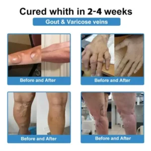 ✅ official store💎Grunsify™ Nano👩‍⚕️(COA) Recommended microneedle joint patch (painless, long-lasting, suitable for arthritis varicose veins and various orthopedic disease）