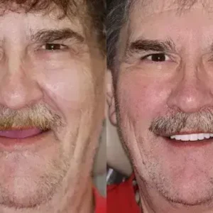 INSIDEEFY™ –🦷Advanced Customized Full Denture Set🦷 {Developed by Harvard University}