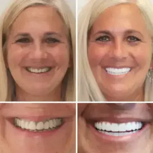 INSIDEEFY™ –🦷Advanced Customized Full Denture Set🦷 {Developed by Harvard University}