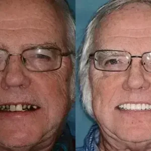 INSIDEEFY™ –🦷Advanced Customized Full Denture Set🦷 {Developed by Harvard University}