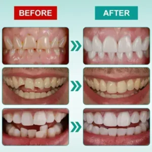 🦷Medazy® Instant Stick-on Dental Veneers (✅Clinically proven, easy-to-use dental veneers trusted by over 8,000 US users for a comfortable, natural smile.)