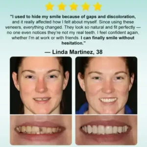 🦷Medazy® Instant Stick-on Dental Veneers (✅Clinically proven, easy-to-use dental veneers trusted by over 8,000 US users for a comfortable, natural smile.)