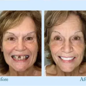 TrueEase™ Dentures