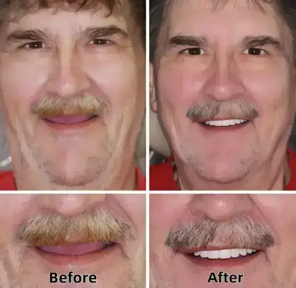 SmileFitPro™–Advanced Custom-Fit Functional Dentures